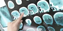 Malattia di Alzheimer. “Il litio, presente nel cervello, rallenta la patologia”