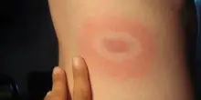 Malattia di Lyme: come si contrae, il decorso e le cure
