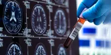 Alzheimer, approvato negli Usa primo test per diagnosi precoce con solo prelievo di sangue