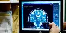 Hai avuto un Tia o mini-ictus? Ecco perché non dovresti sottovalutare le conseguenze