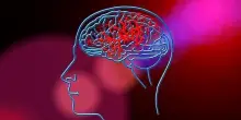 Ictus e infarto, con la tecnica “aspira e ruota” attacco diretto ai trombi pericolosi