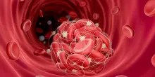 Ictus ischemico, grazie ai farmaci si può sciogliere il trombo (ma se si fa presto)