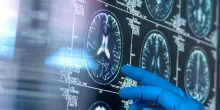 Alzheimer, entra in gioco il fattore genetico. Ecco chi rischia di più al mondo