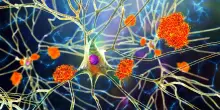 Lo zucchero nei neuroni potrebbe proteggere dall’Alzheimer