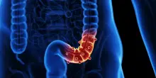 Diverticolite: più fibre, meno infiammazione