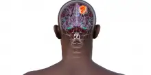 Che cos’è il glioma cerebrale dell’attrice Kelley Mack e chi colpisce