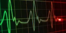 Infarto, con l’Intelligenza Artificiale cure su misura per i casi più complessi