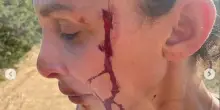 Sara Bluma, le foto delle violenze domestiche. “Troppo tempo in silenzio”. Can Yaman: “Sono con te”