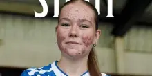 Scozia, giovane calciatrice insultata per l’acne: il Kilmarnock cancella il post dai social