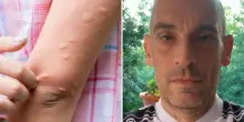 Punto da un insetto mentre fa una passeggiata, Luca muore in maniera atroce: “In piena salute e sportivo”. Orrore