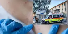 “Molto contagiosa”. Allarme in Italia, boom della malattia infettiva: a cosa fare attenzione, i sintomi