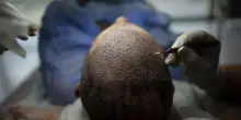 Paga 1700 euro per un trapianto di capelli, poi succede la tragedia: si sente male e muore! La scoperta shock
