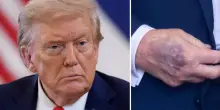Il livido sulla mano di Trump cosa significa? Quali problemi di salute può svelare