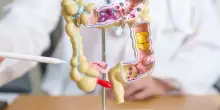 “Tumore al colon, i 5 segnali da non ignorare”: l’allarme dell’oncologo, a cosa dobbiamo stare attenti