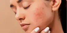 Intolleranze alimentari nascoste: possono essere la causa dell’acne persistente?